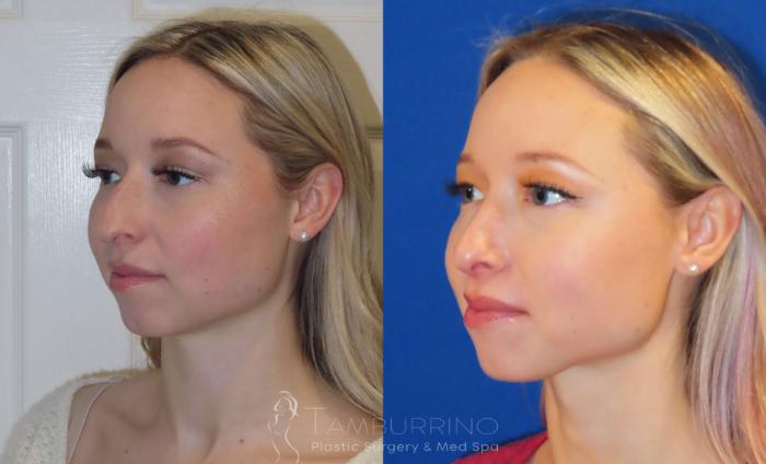 Before & After Rhinoplasty Case 12 Left Oblique Rhinoplasty View in Doylestown, PA