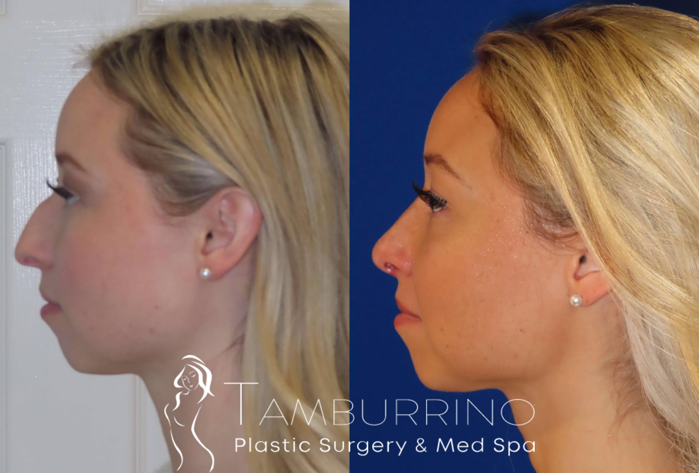 Before & After Rhinoplasty Case 12 Left Side Rhinoplasty View in Doylestown, PA