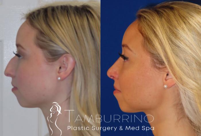Before & After Rhinoplasty Case 12 Left Side Rhinoplasty View in Doylestown, PA