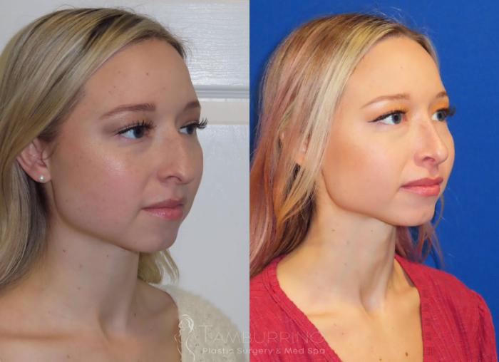 Before & After Rhinoplasty Case 12 Right Oblique Rhinoplasty View in Doylestown, PA