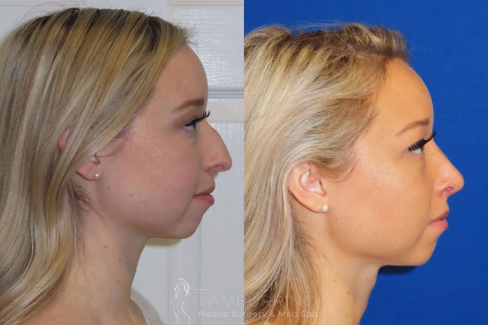 Before & After Rhinoplasty Case 12 Right Side Rhinoplasty View in Doylestown, PA