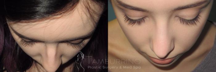 Before & After Rhinoplasty Case 18 Bird's Eye View in Doylestown, PA