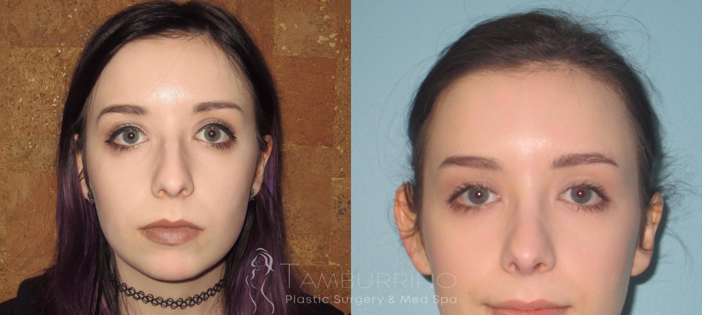 Before & After Rhinoplasty Case 18 Frontal View in Doylestown, PA