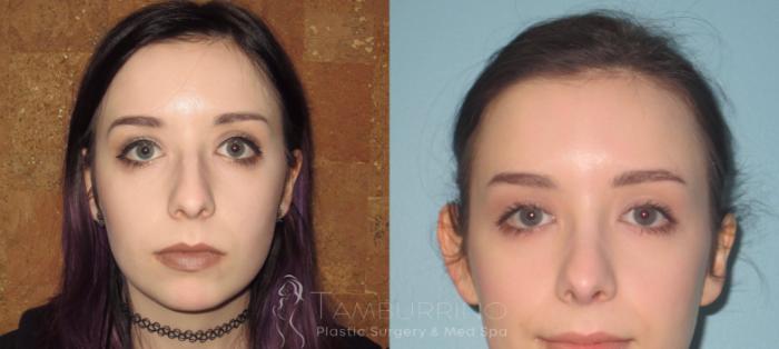 Before & After Rhinoplasty Case 18 Frontal View in Doylestown, PA