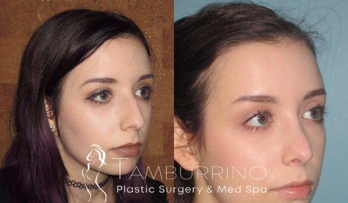 Before & After Rhinoplasty Case 18 Oblique #1 View in Doylestown, PA