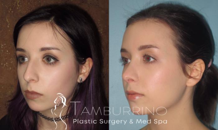 Before & After Rhinoplasty Case 18 Oblique #2 View in Doylestown, PA