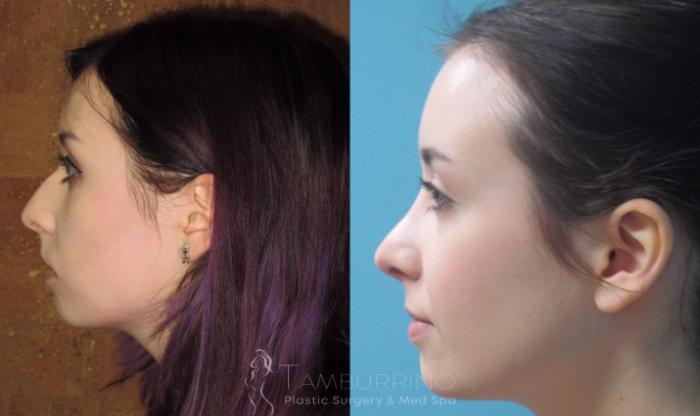Before & After Rhinoplasty Case 18 Side #2 View in Doylestown, PA