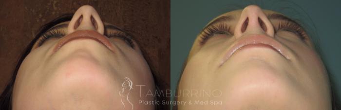 Before & After Rhinoplasty Case 18 Worm's Eye View in Doylestown, PA