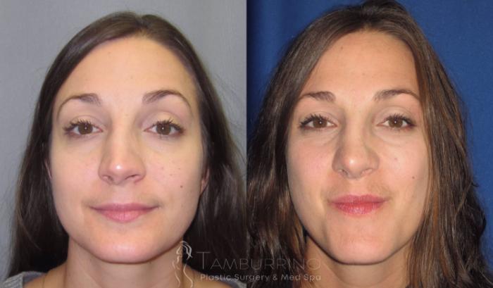 Before & After Rhinoplasty Case 19 Frontal View in Doylestown, PA