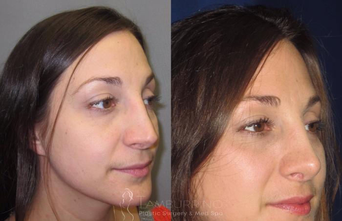 Before & After Rhinoplasty Case 19 Oblique #1 View in Doylestown, PA