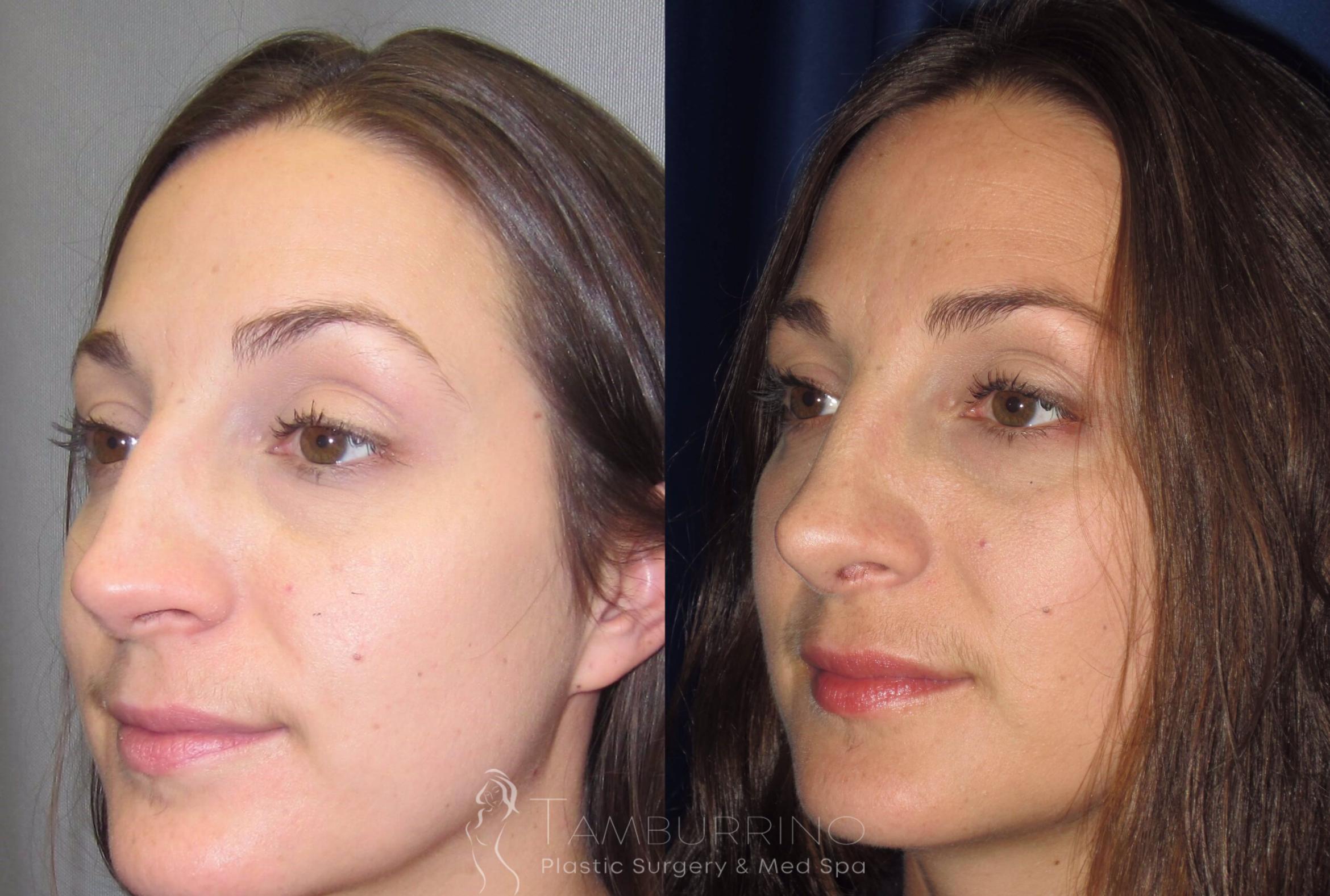 Before & After Rhinoplasty Case 19 Oblique #2 View in Doylestown, PA