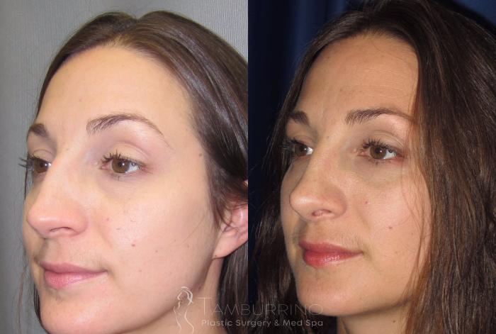 Before & After Rhinoplasty Case 19 Oblique #2 View in Doylestown, PA