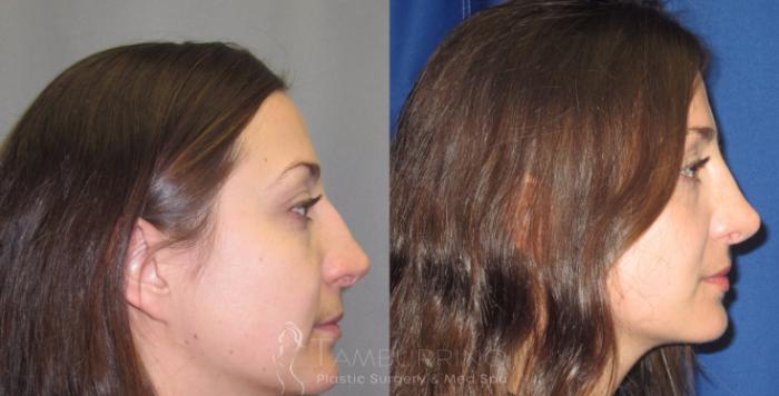 Before & After Rhinoplasty Case 19 Side #1 View in Doylestown, PA