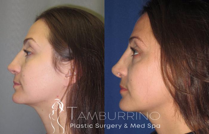 Before & After Rhinoplasty Case 19 Side #2 View in Doylestown, PA