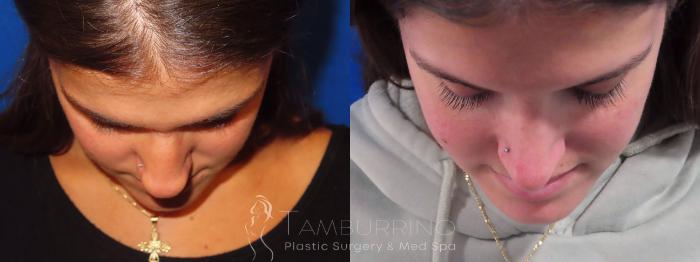 Before & After Rhinoplasty Case 27 Bird's Eye View in Doylestown, PA