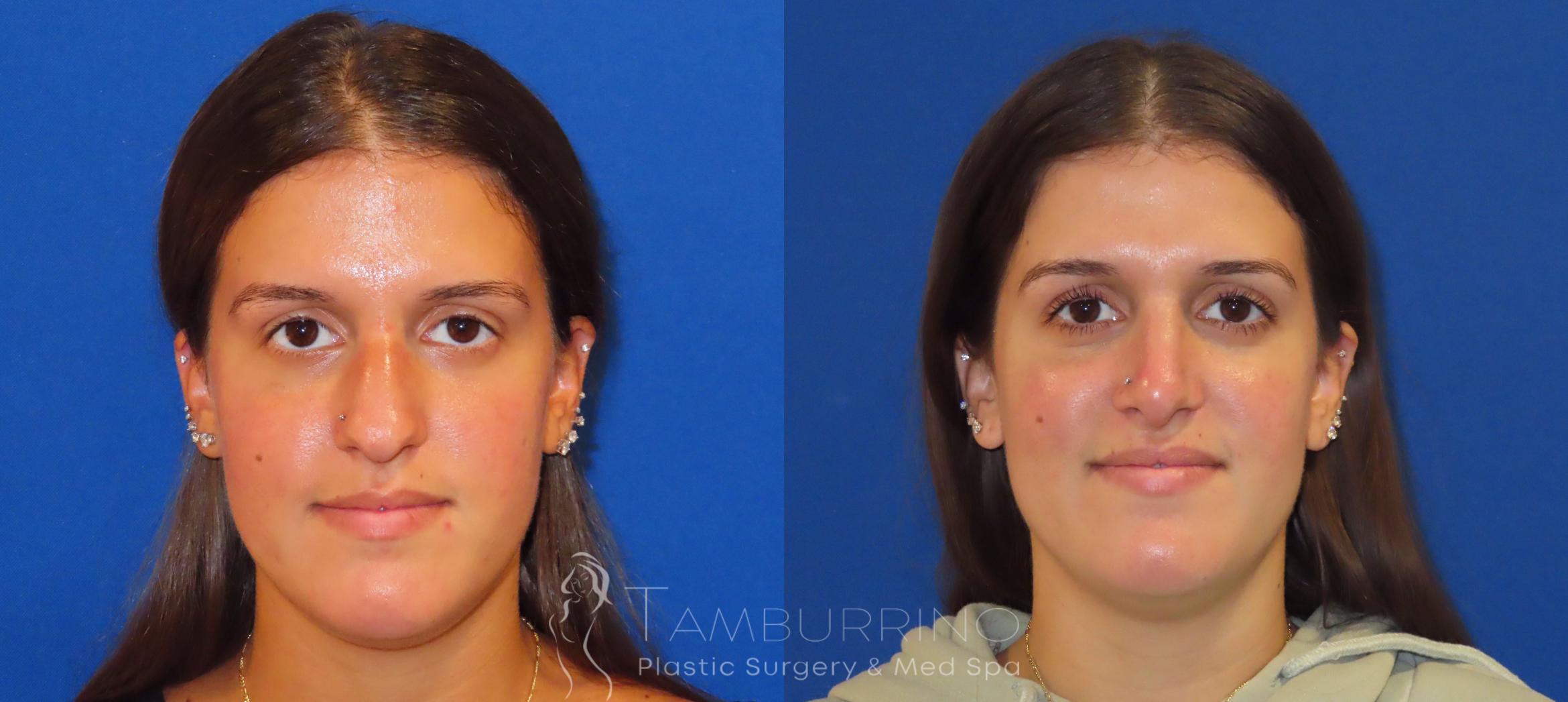 Before & After Rhinoplasty Case 27 Front - Open Rhinoplasty View in Doylestown, PA