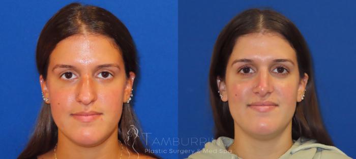 Before & After Rhinoplasty Case 27 Front - Open Rhinoplasty View in Doylestown, PA