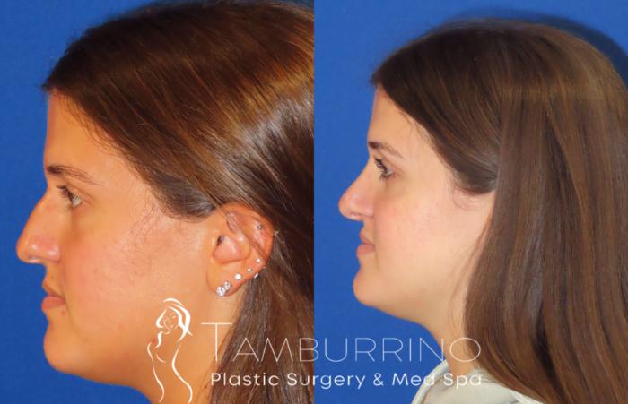 Before & After Rhinoplasty Case 27 L-Side Open Rhinoplasty View in Doylestown, PA