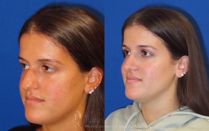 Before & After Rhinoplasty Case 27 Oblique - Open Rhinoplasty View in Doylestown, PA