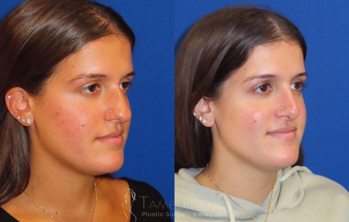 Before & After Rhinoplasty Case 27 Right Oblique View in Doylestown, PA