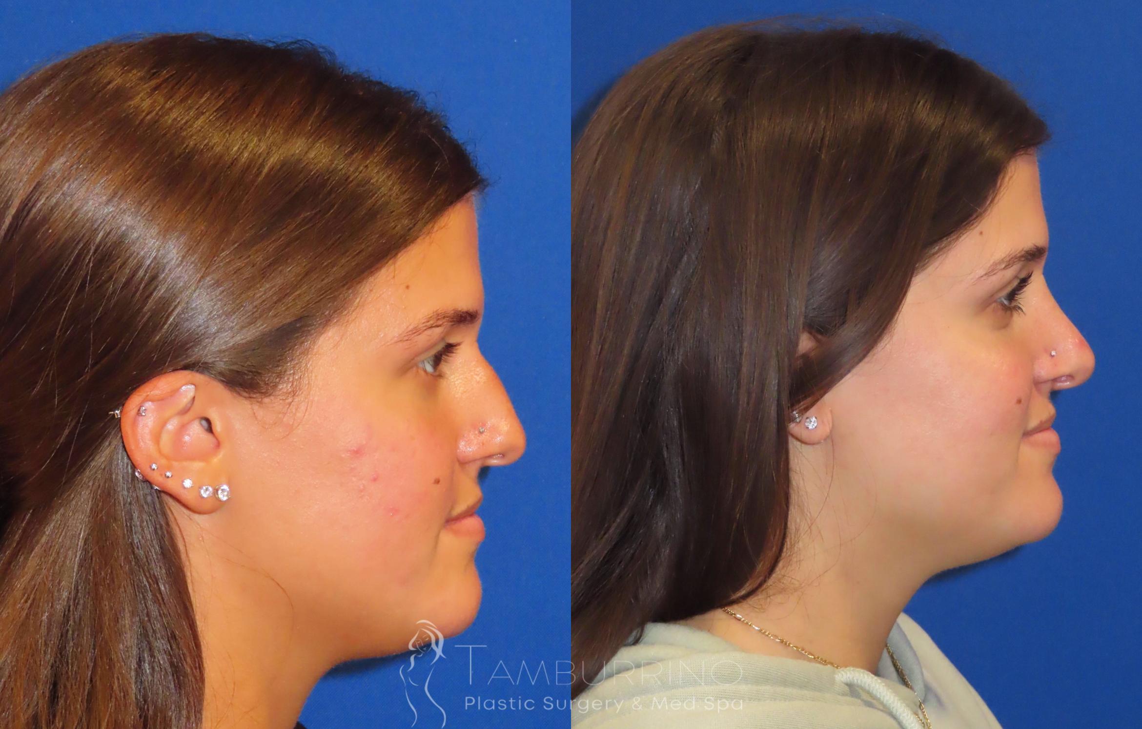 Before & After Rhinoplasty Case 27 R-Side Open Rhinoplasty View in Doylestown, PA