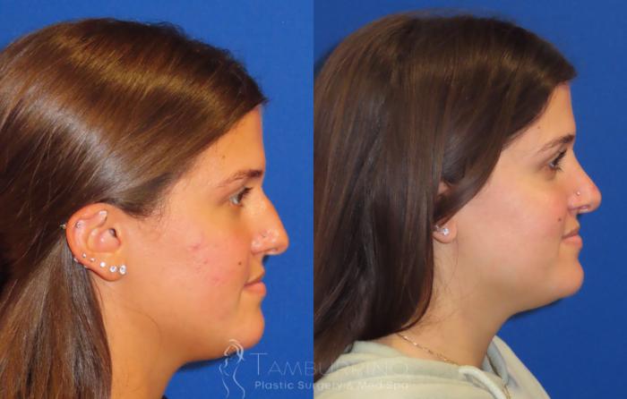 Before & After Rhinoplasty Case 27 R-Side Open Rhinoplasty View in Doylestown, PA