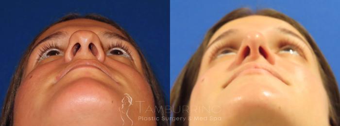 Before & After Rhinoplasty Case 27 Worm's Eye View in Doylestown, PA