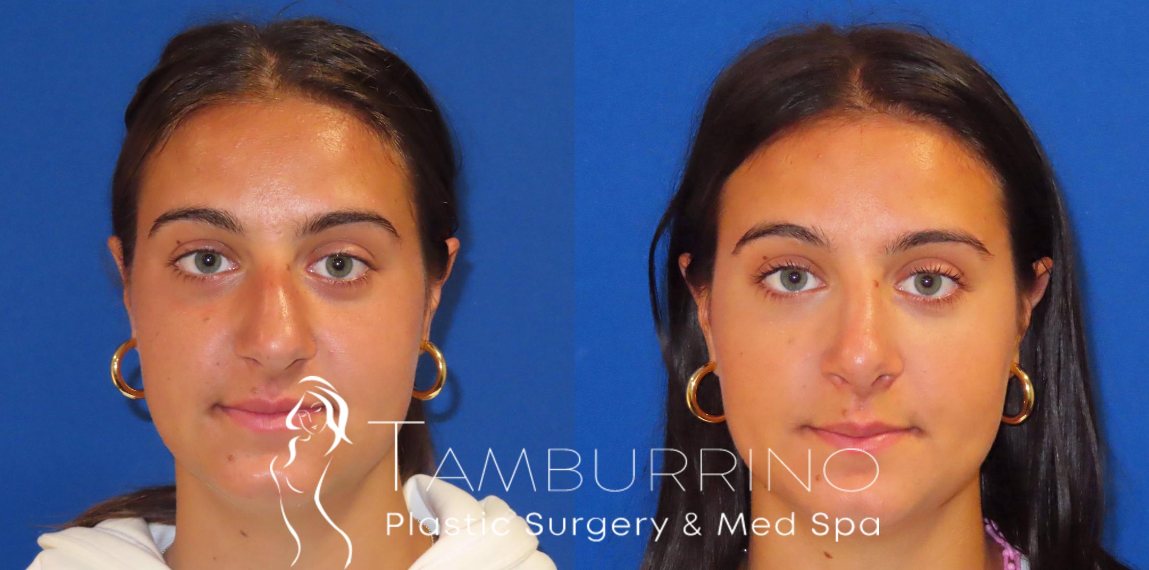 Before & After Rhinoplasty Case 40 Frontal View in Doylestown, PA