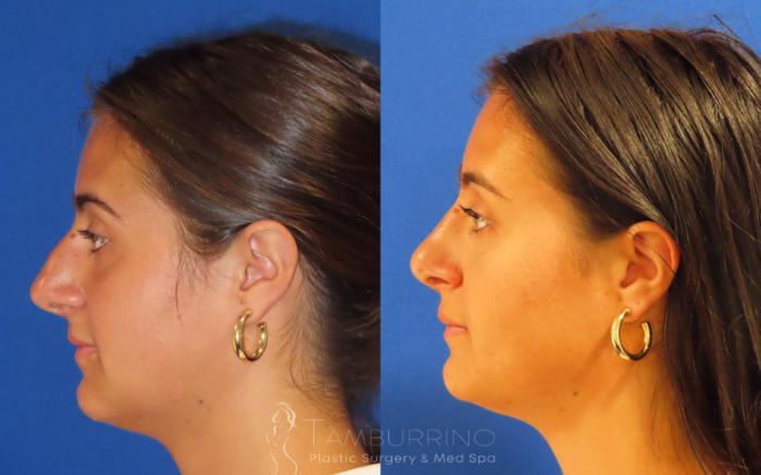 Before & After Rhinoplasty Case 40 Left Lateral View in Doylestown, PA