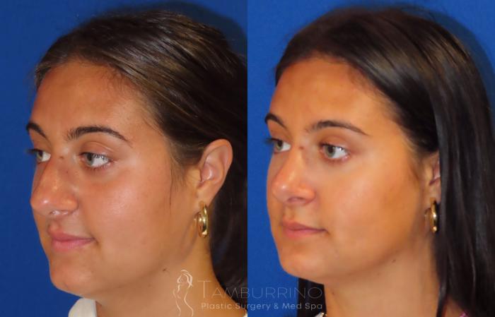 Before & After Rhinoplasty Case 40 Left Oblique View in Doylestown, PA