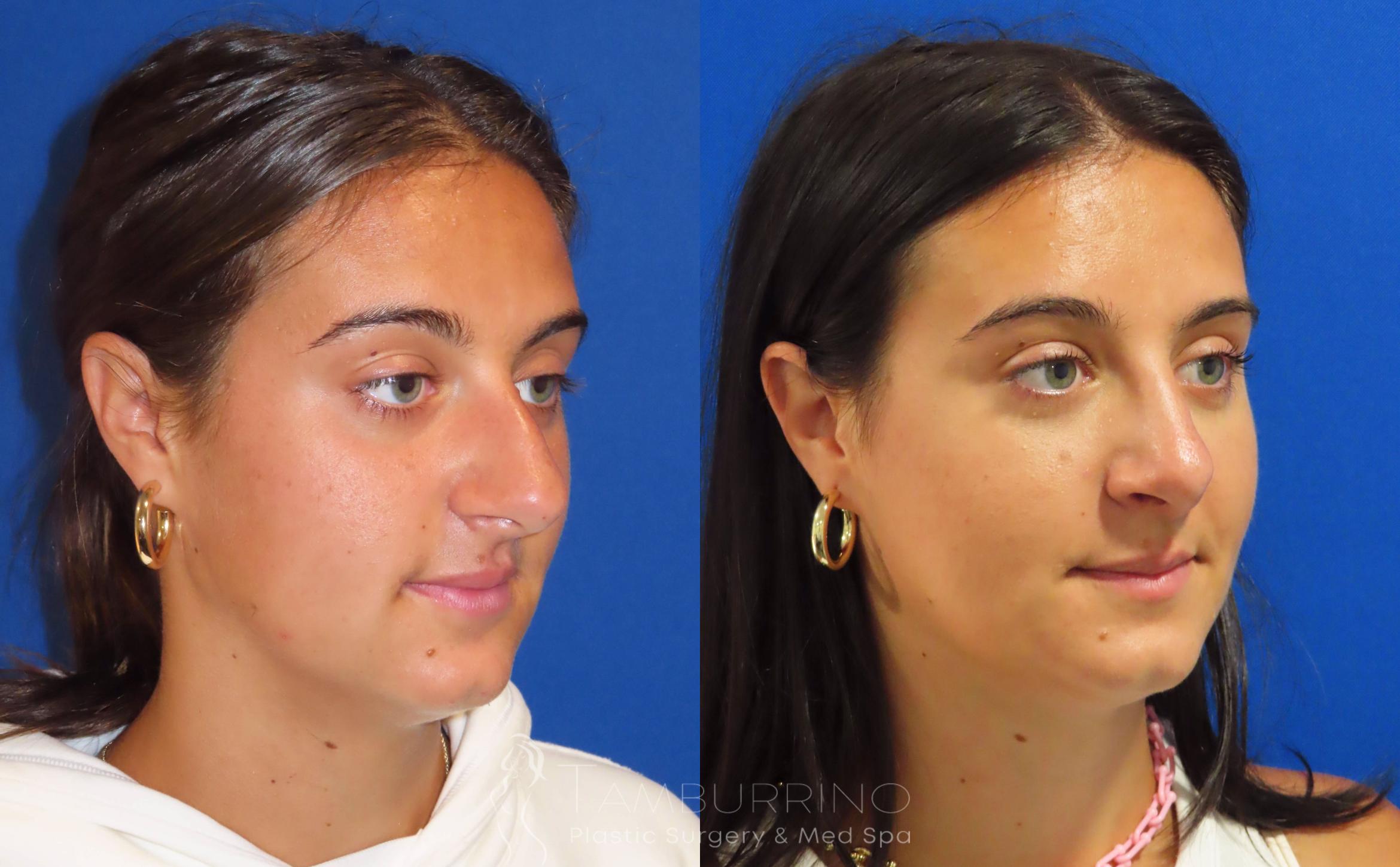 Before & After Rhinoplasty Case 40 Right Oblique View in Doylestown, PA