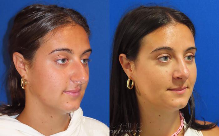 Before & After Rhinoplasty Case 40 Right Oblique View in Doylestown, PA