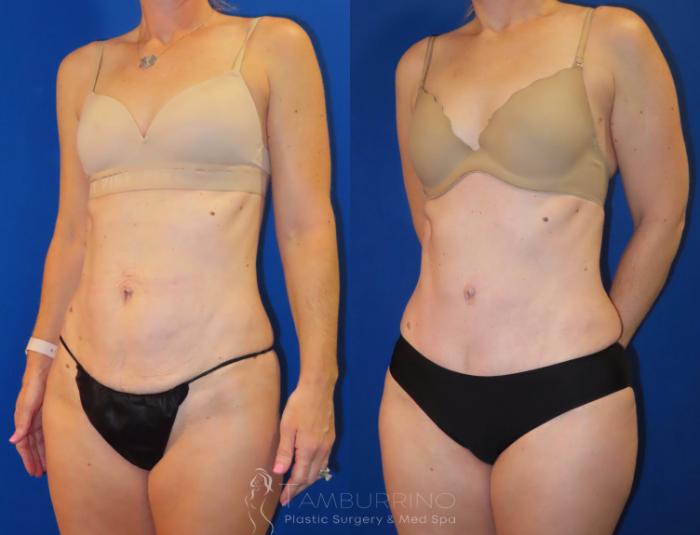 Before & After Tummy Tuck Case 34 Left Oblique View in Doylestown, PA