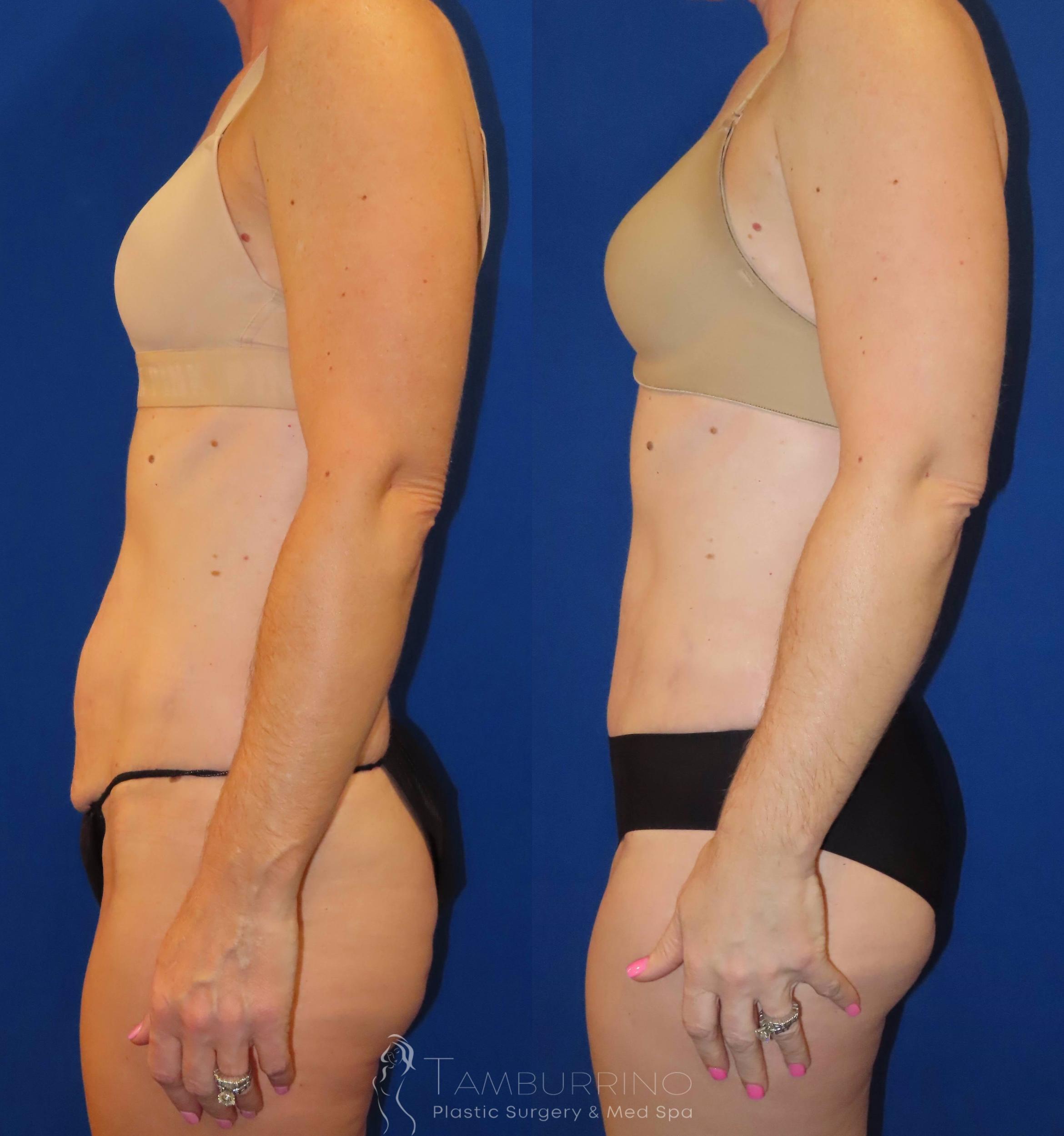 Before & After Tummy Tuck Case 34 Left Side View in Doylestown, PA