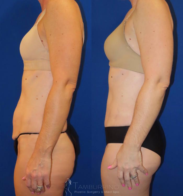 Before & After Tummy Tuck Case 34 Left Side View in Doylestown, PA