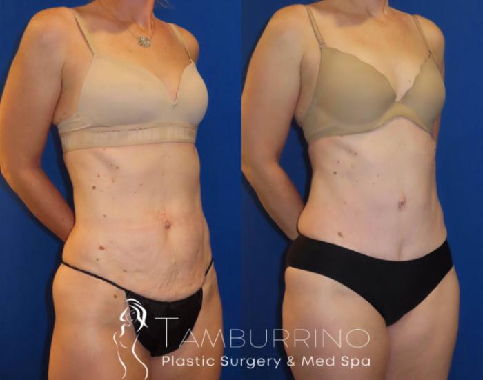Before & After Tummy Tuck Case 34 Right Oblique View in Doylestown, PA