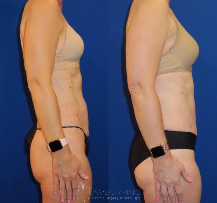 Before & After Tummy Tuck Case 34 Right Side View in Doylestown, PA