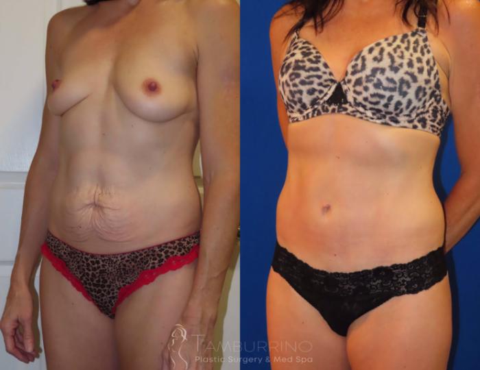 Before & After Tummy Tuck Case 35 Left Oblique View in Doylestown, PA