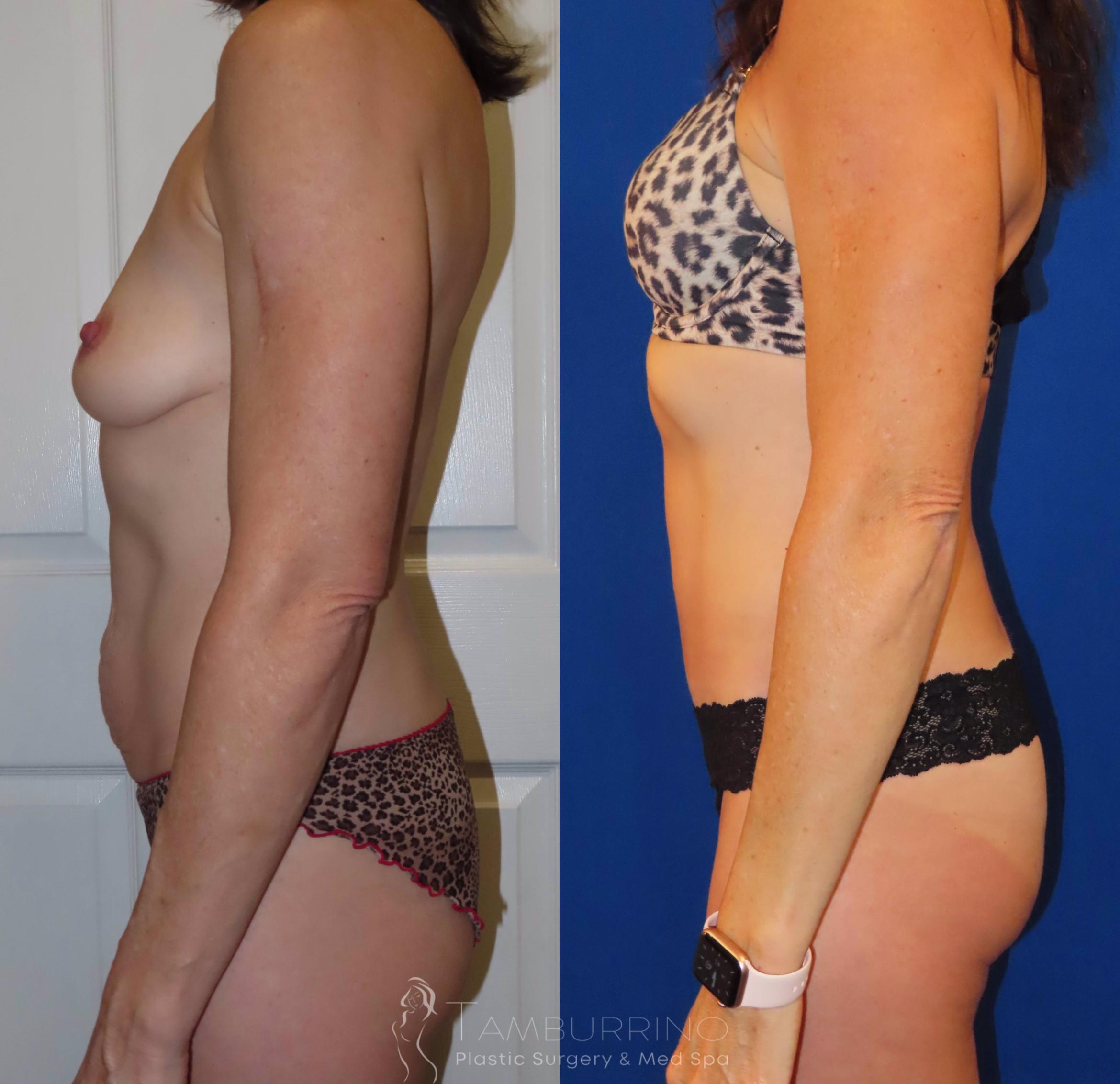 Before & After Tummy Tuck Case 35 Left Side View in Doylestown, PA