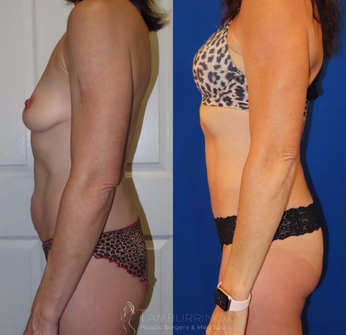 Before & After Tummy Tuck Case 35 Left Side View in Doylestown, PA