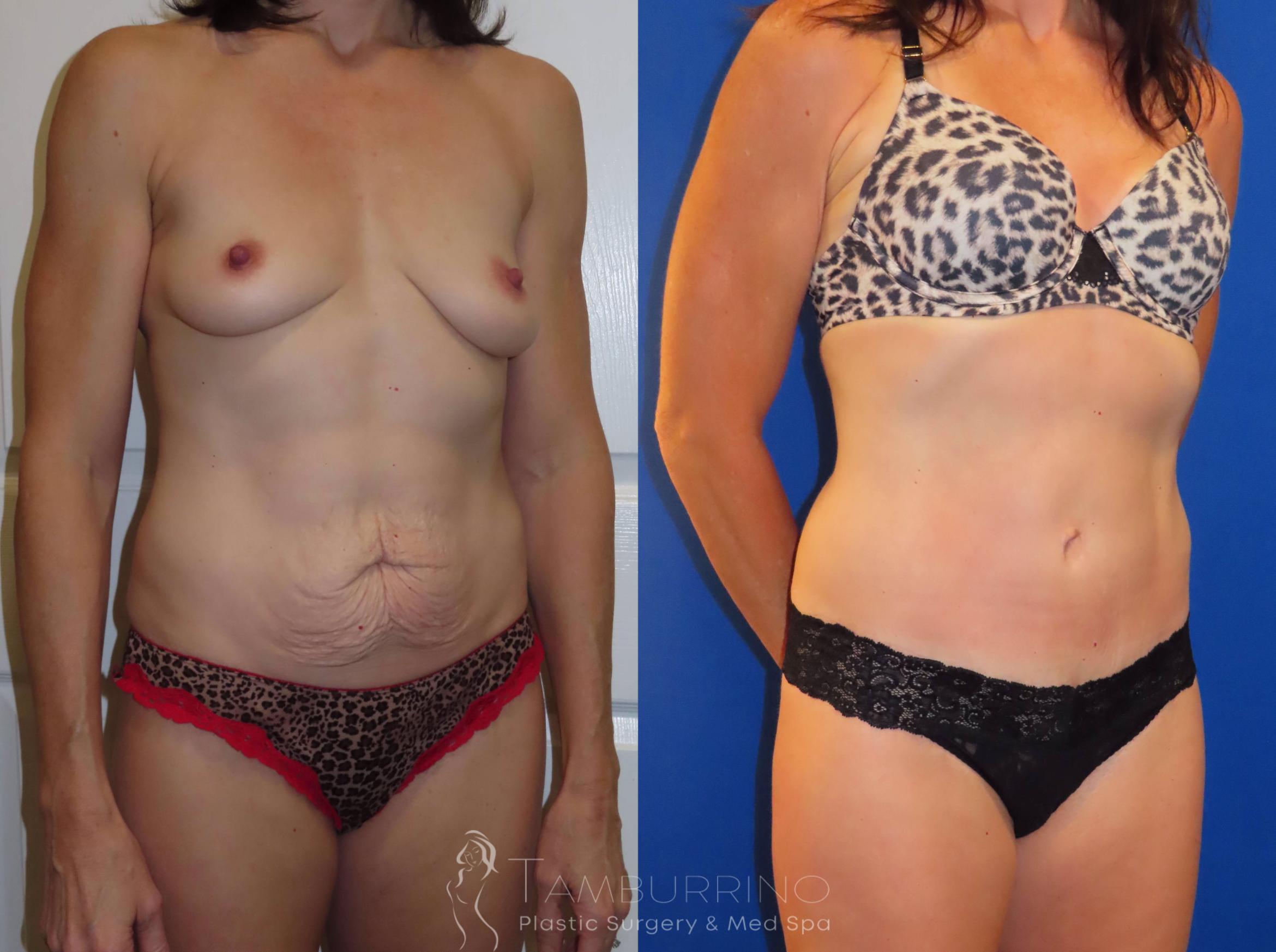 Before & After Tummy Tuck Case 35 Right Oblique View in Doylestown, PA