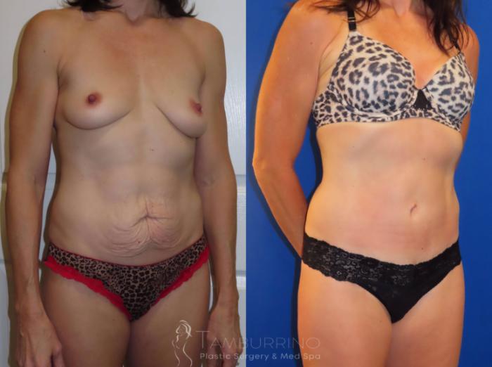 Before & After Tummy Tuck Case 35 Right Oblique View in Doylestown, PA