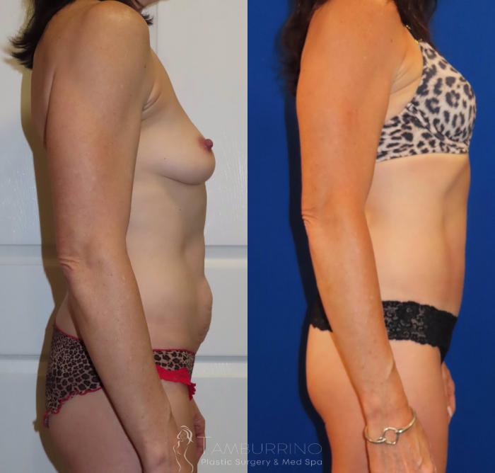 Before & After Tummy Tuck Case 35 Right Side View in Doylestown, PA