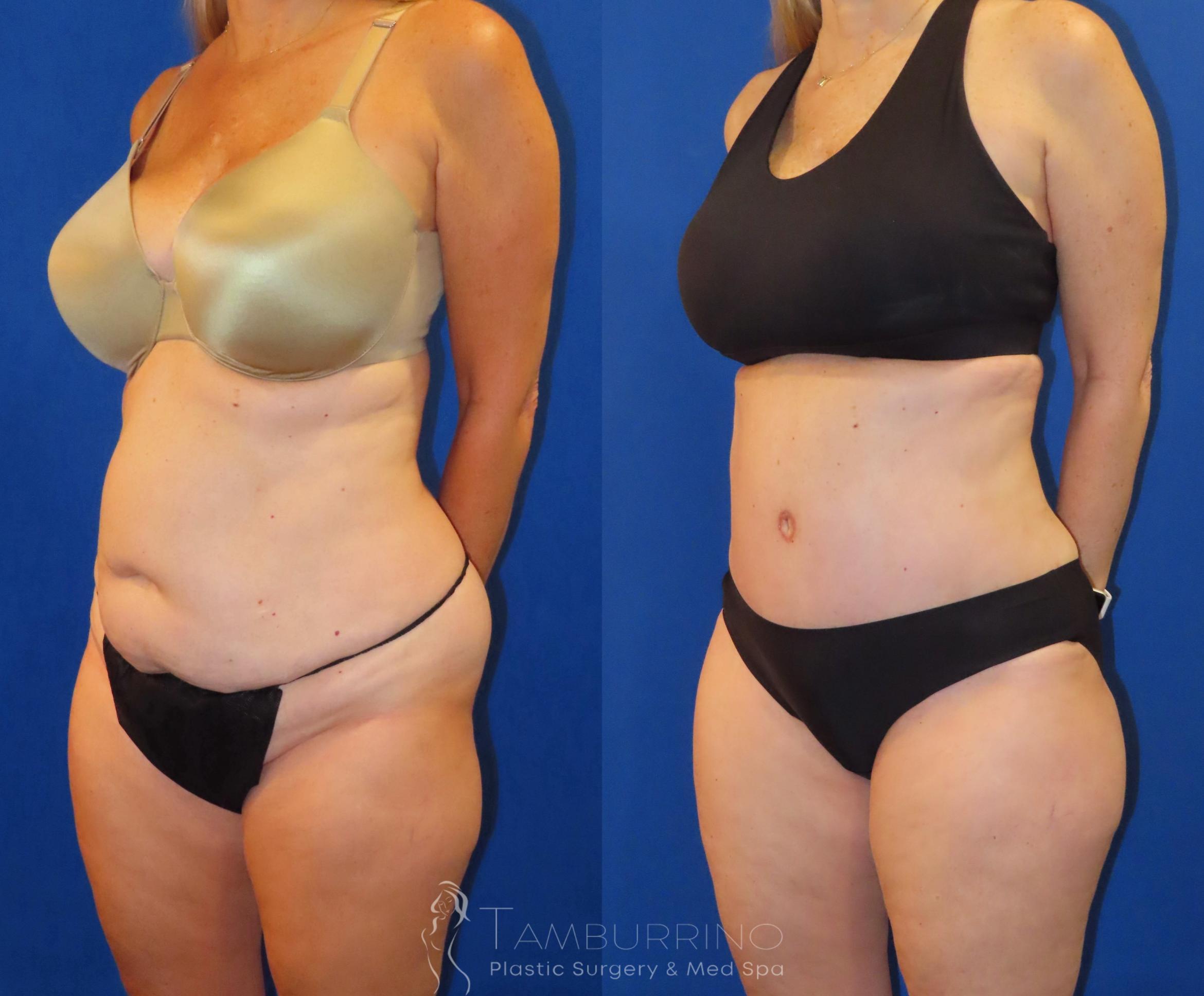 Before & After Tummy Tuck Case 60 Left Oblique View in Doylestown, PA