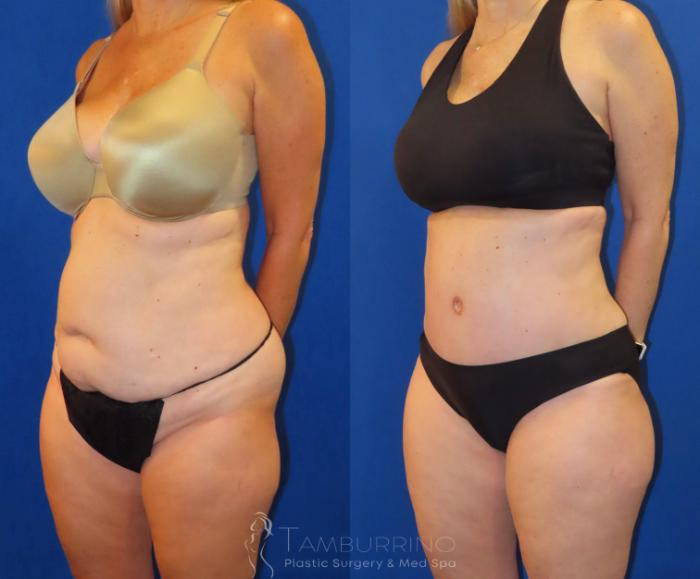 Before & After Tummy Tuck Case 60 Left Oblique View in Doylestown, PA