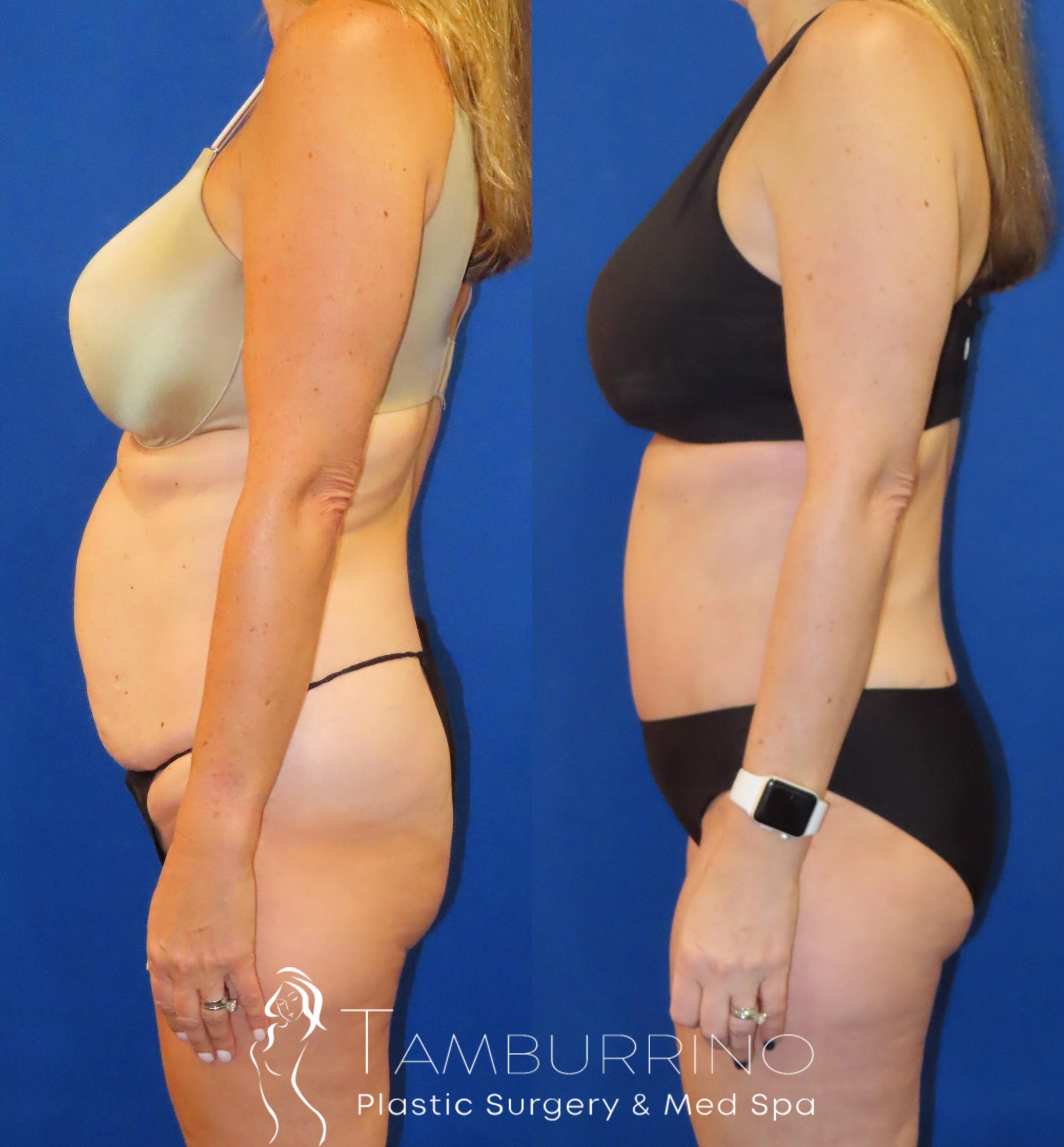 Before & After Tummy Tuck Case 60 Left Side View in Doylestown, PA