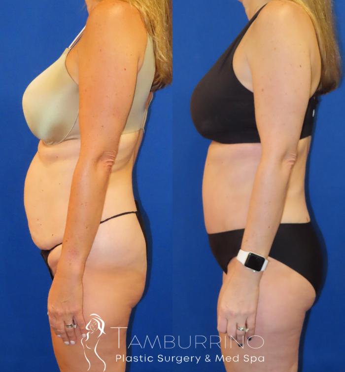 Before & After Tummy Tuck Case 60 Left Side View in Doylestown, PA