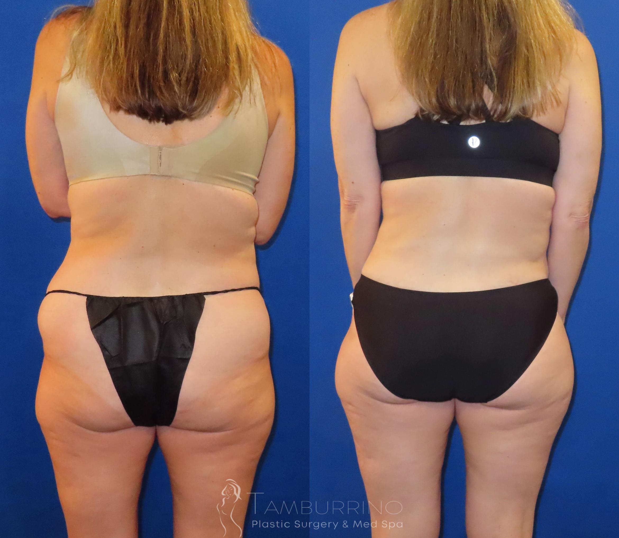 Before & After Tummy Tuck Case 60 Posterior Flank Liposuction View in Doylestown, PA
