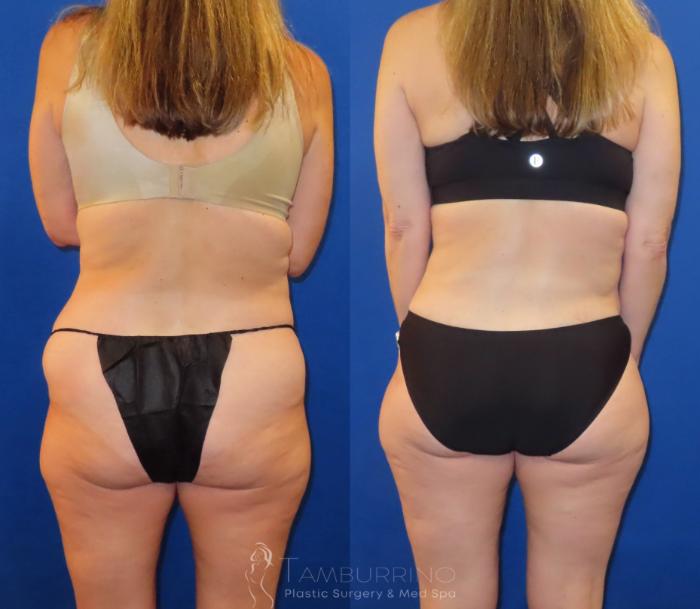 Before & After Tummy Tuck Case 60 Posterior Flank Liposuction View in Doylestown, PA