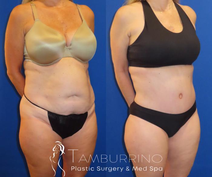 Before & After Tummy Tuck Case 60 Right Oblique View in Doylestown, PA